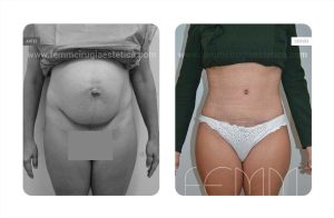 abdominoplastia-secuela-embarazo_1a